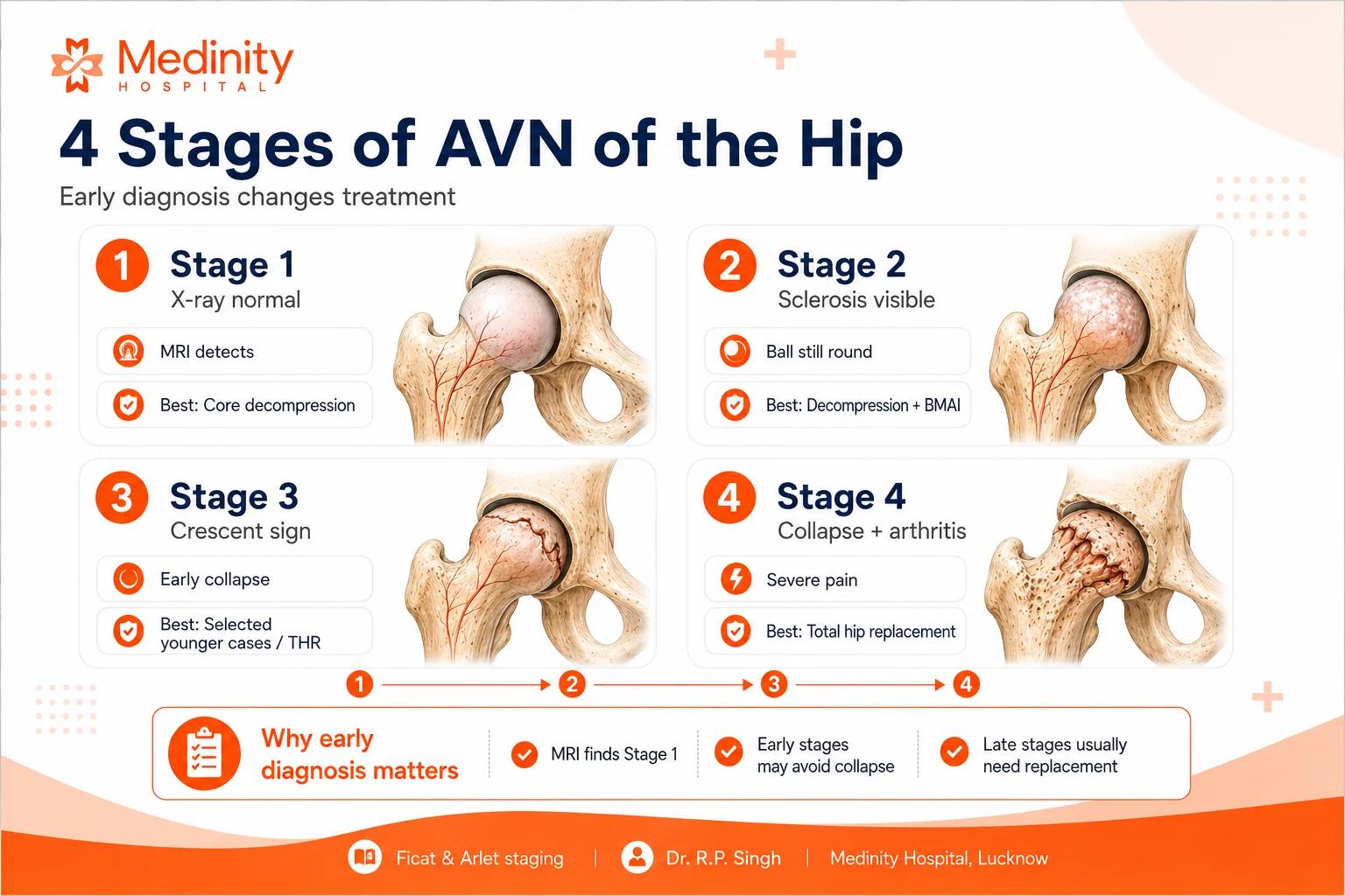 4 stages AVN hip Ficat Arlet classification Dr R.P. Singh Medinity Hospital Lucknow