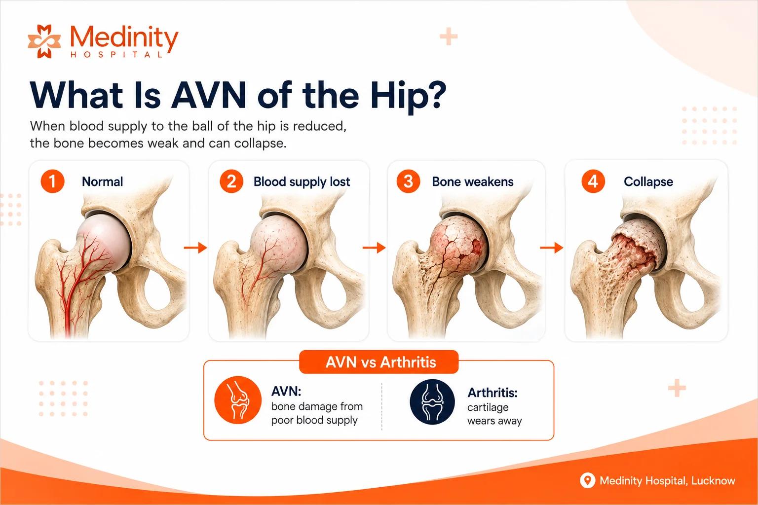 Avascular necrosis AVN of hip progression from normal to collapse Medinity Hospital Lucknow