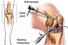 arthroscope